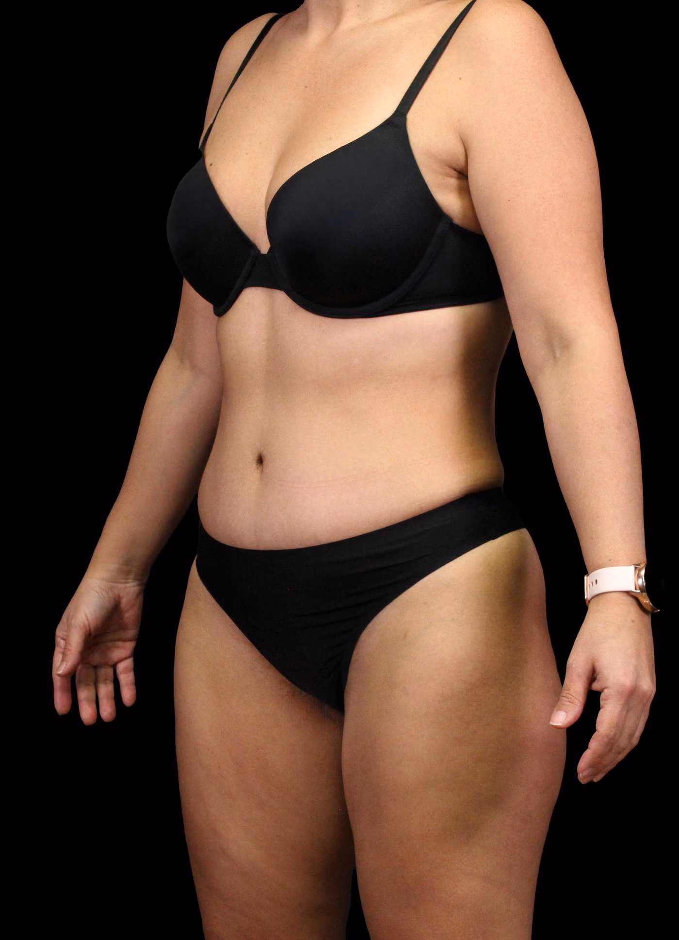 Abdominoplasty Case 116