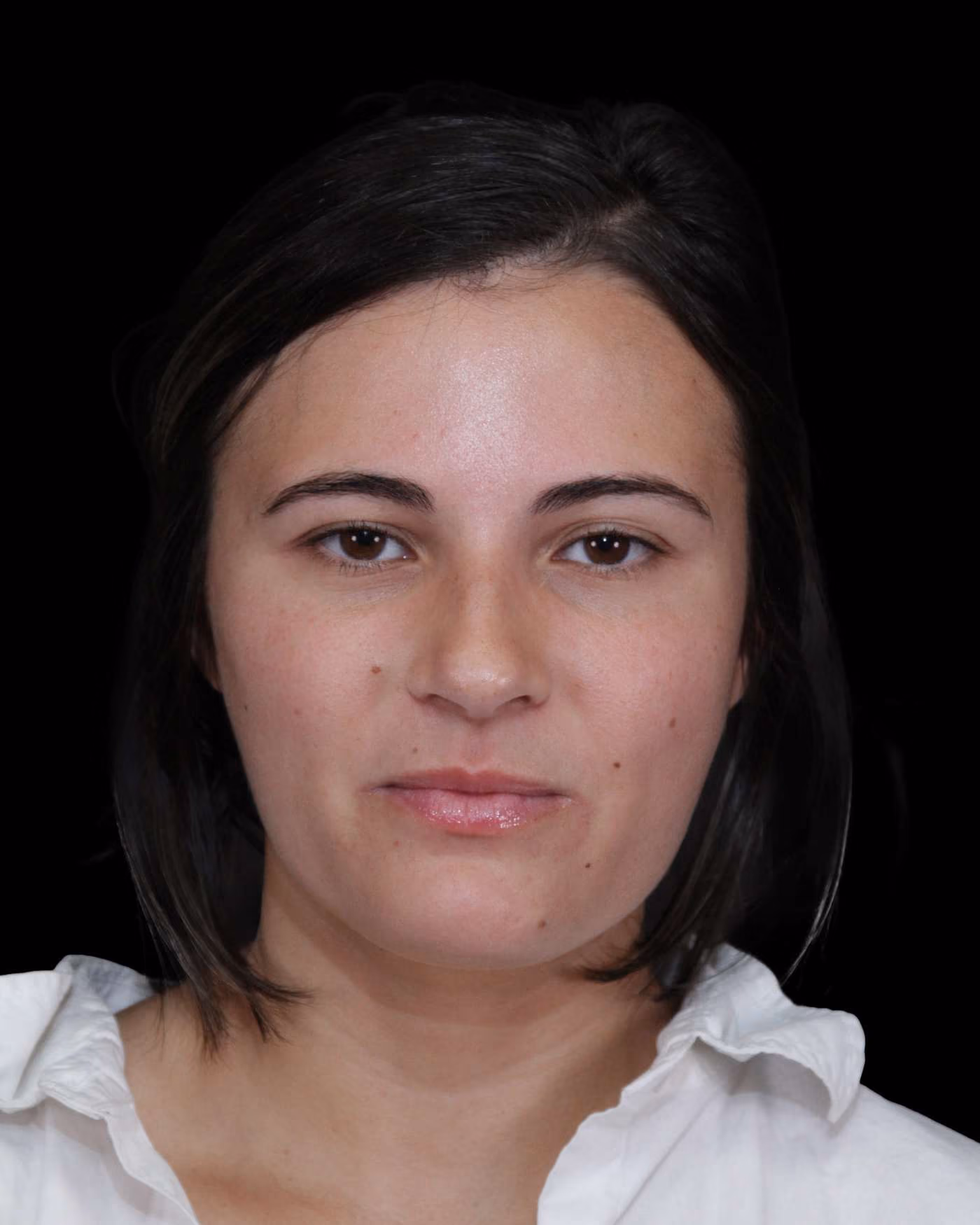 Buccal Fat Case 136
