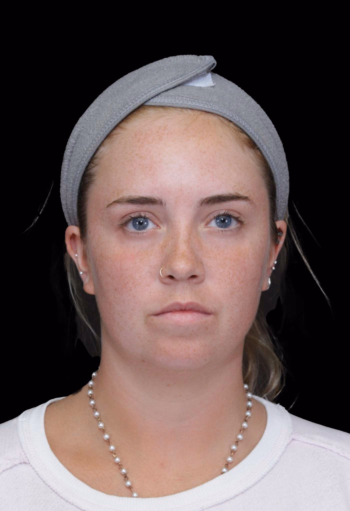 Chin Implant Case 144
