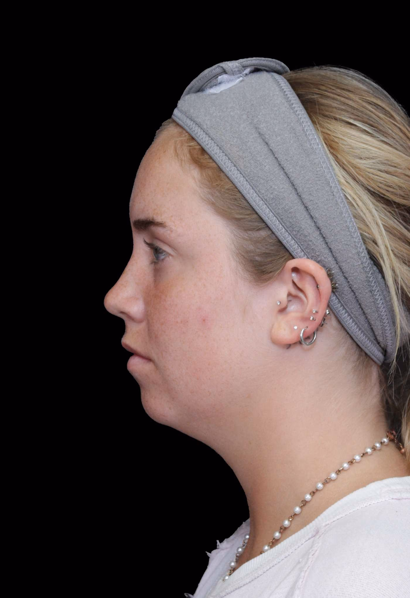 Chin Implant Case 144