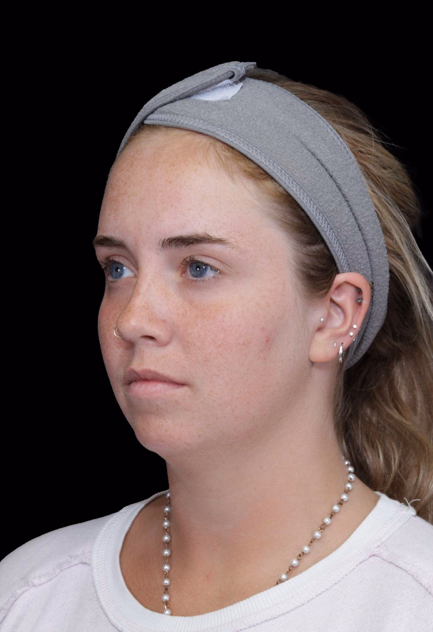 Chin Implant Case 144