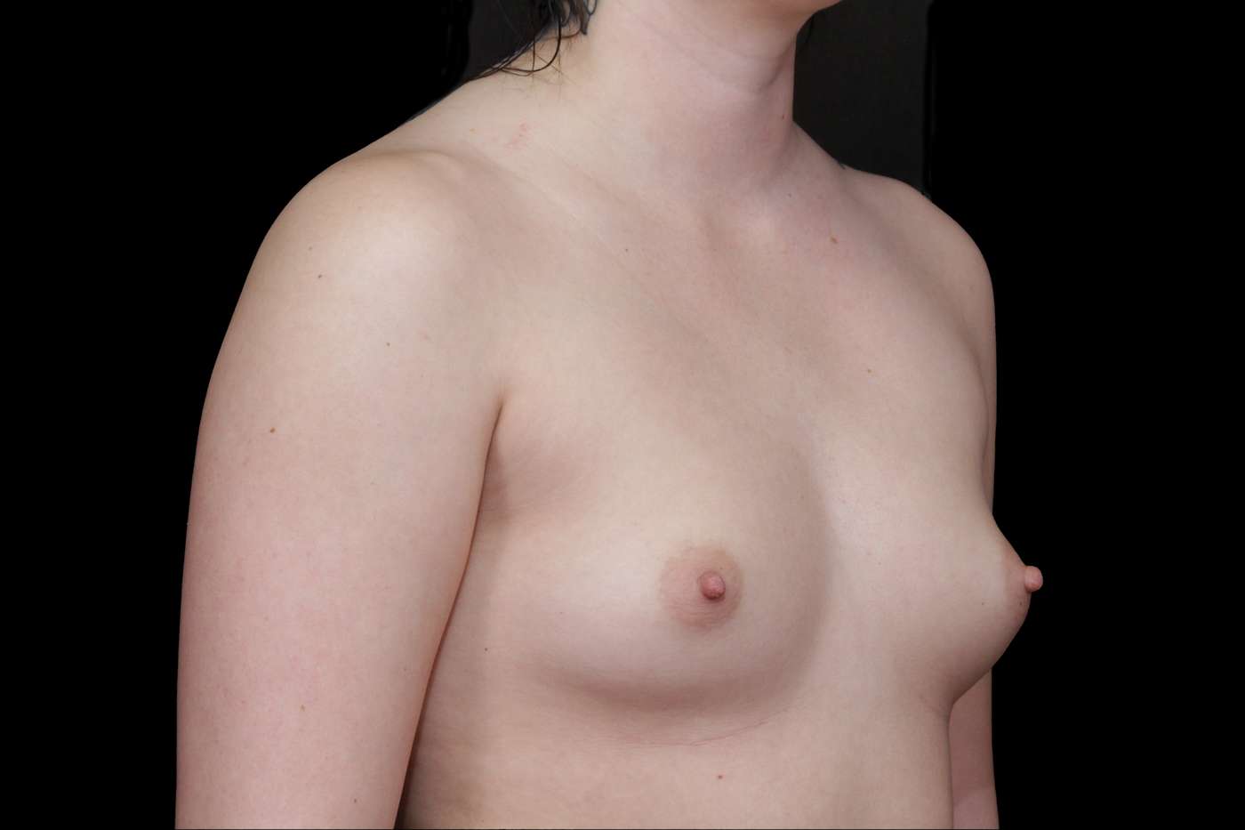 Breast Augmentation Case 033