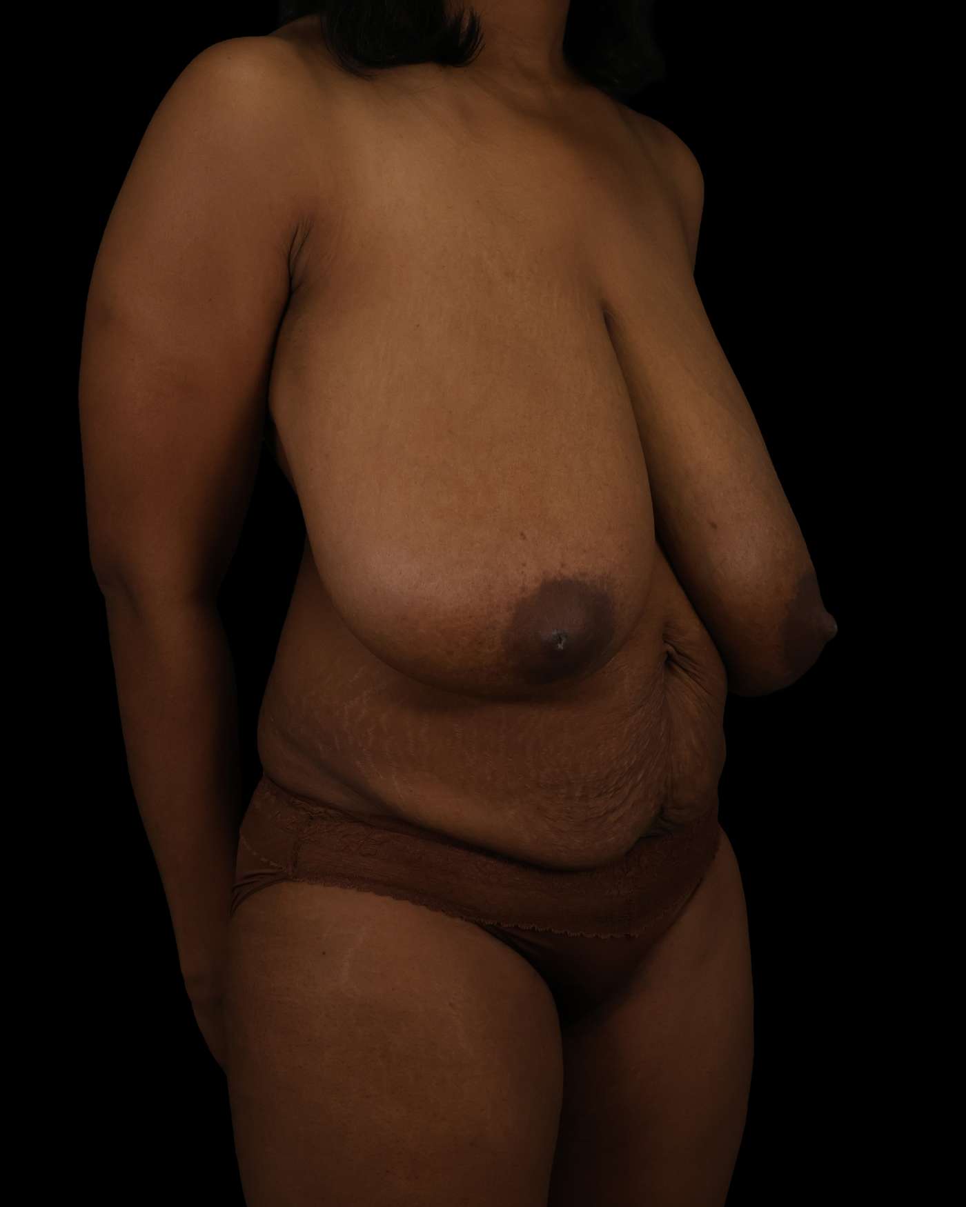 Breast Reduction Case 209