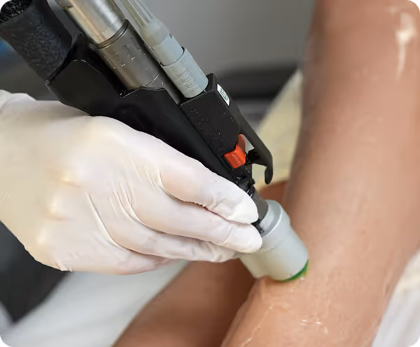 Hands Laser Hair Removal