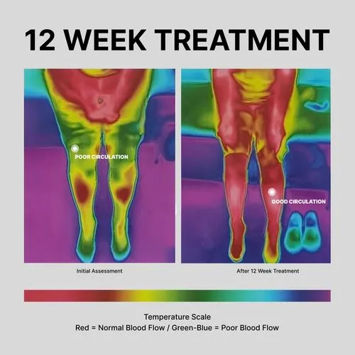 The image displays a thermal imaging comparison of a person's lower body circulation, showing "Poor Circulation" in cooler colors before treatment and "Good Circulation" in warmer colors after a 12-week treatment program, with a temperature scale indicating red as normal blood flow and green-blue as poor blood flow.