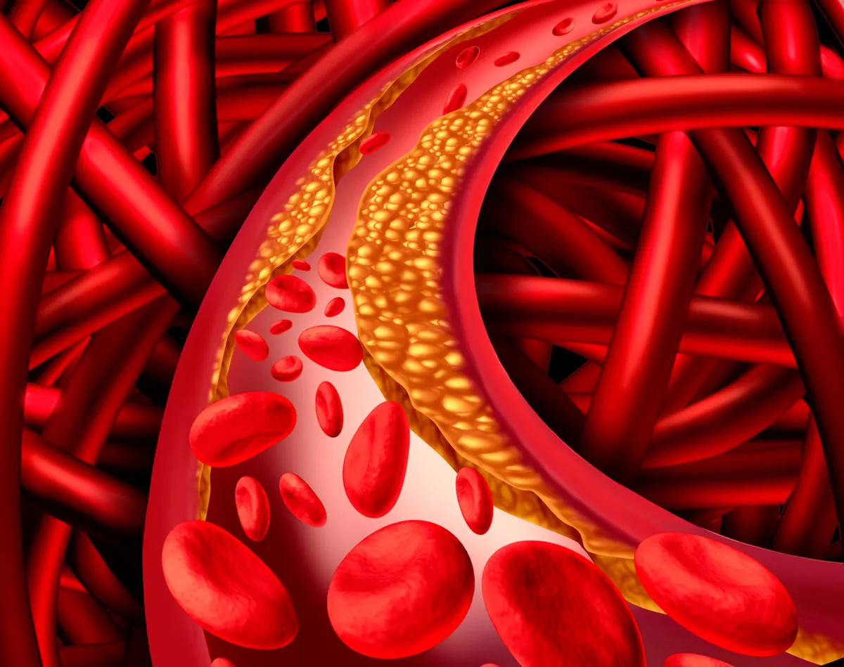 A graphic of Atherosclerosis