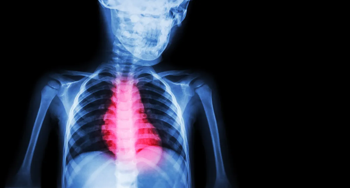 A graphic of a person with cardiomyopathy