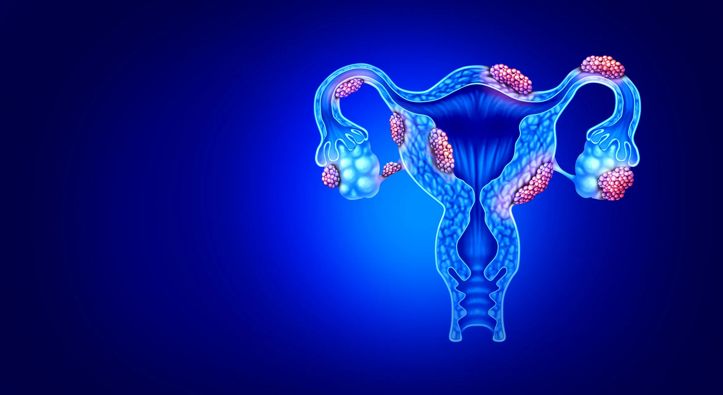 A graphic of Uterine Fibroid Embolization