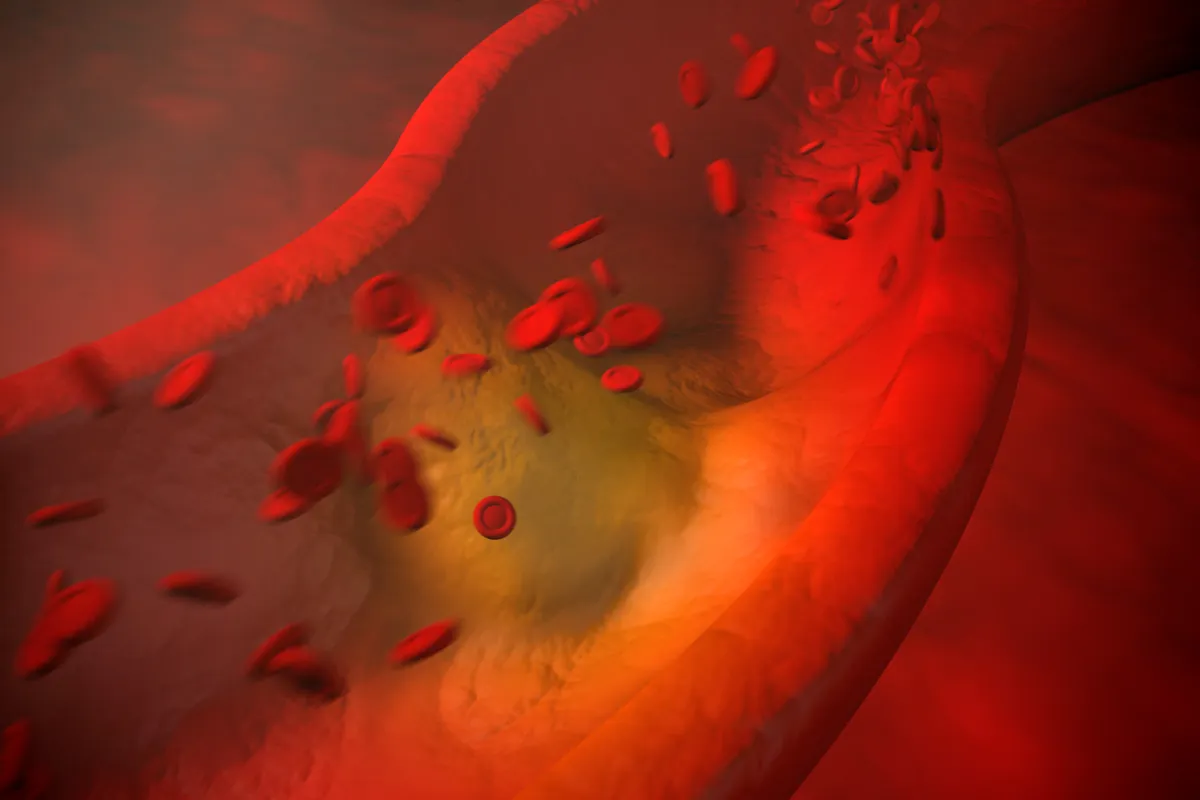 A graphic of High Cholesterol