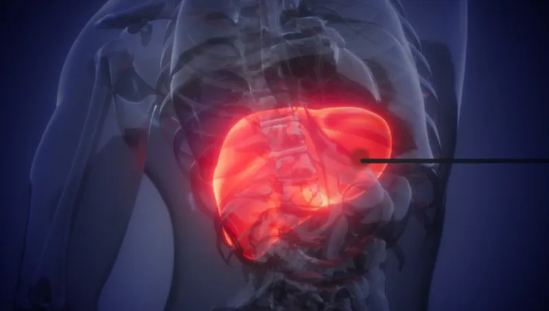 A graphic of Tumor Ablation