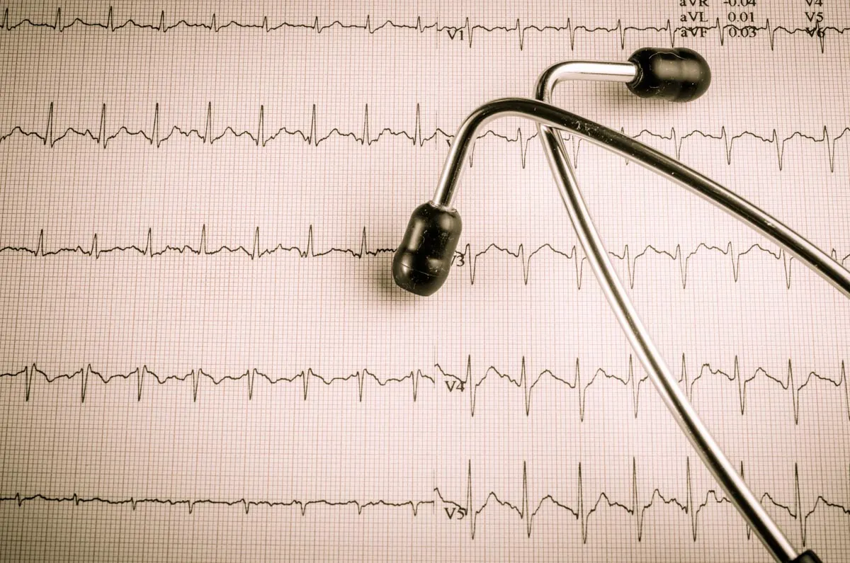 A stethoscope placed on a cardiogram