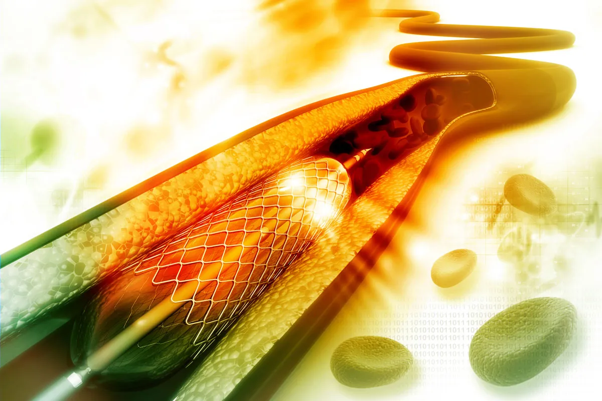 An illustration of an Angioplasty with Stent