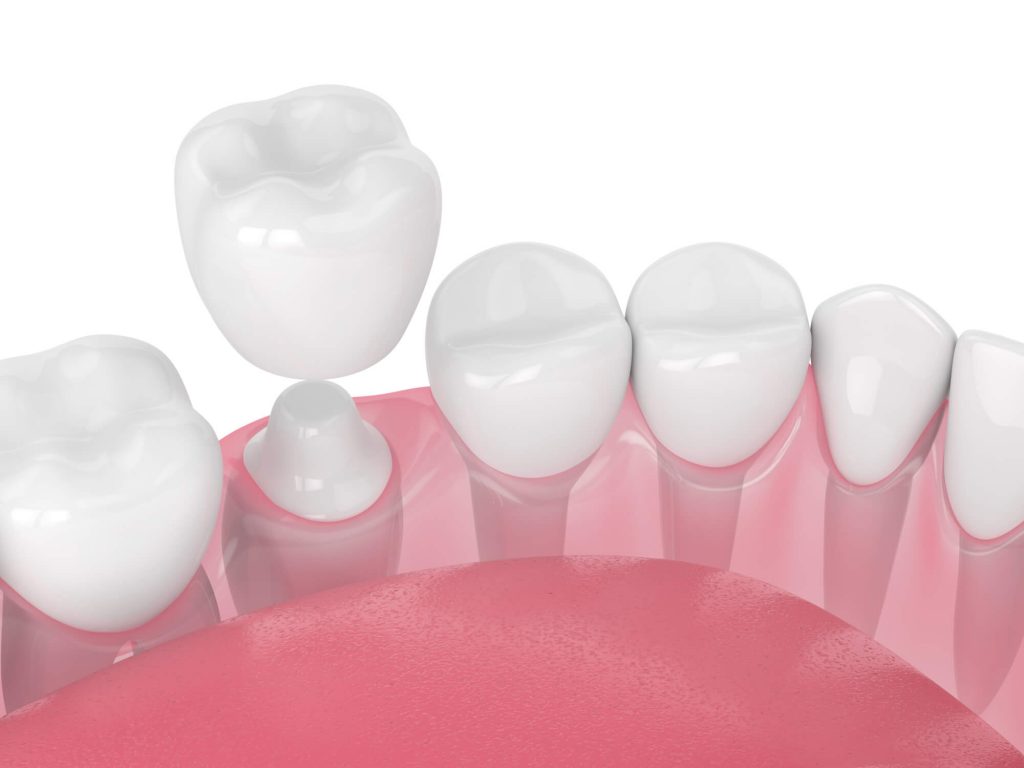  Dental Crowns n 33317 
