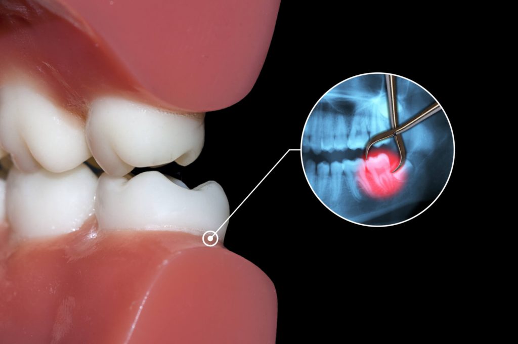 Diagram of a tooth causing severe pain.