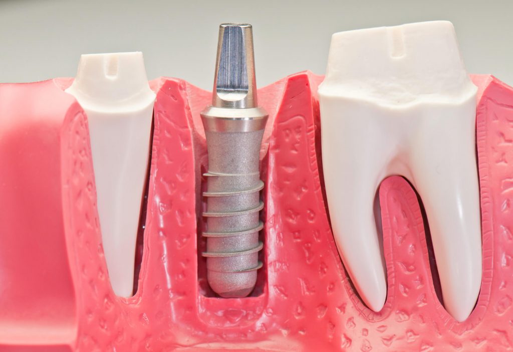 implants Same day 33324