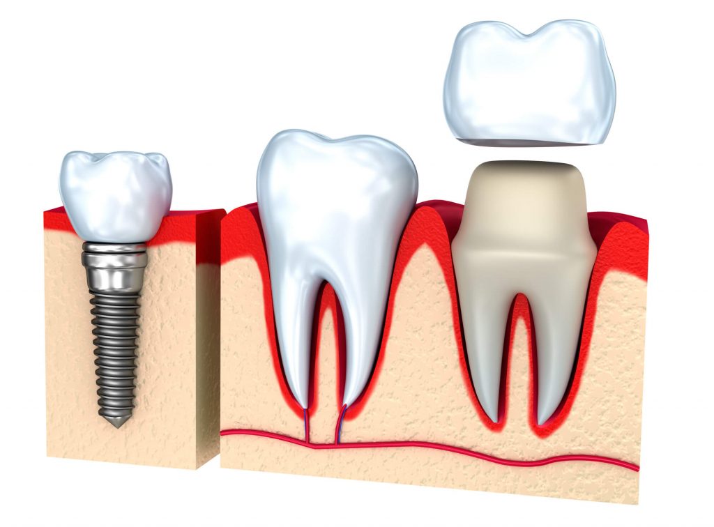 Diagram of crowns in 33330.