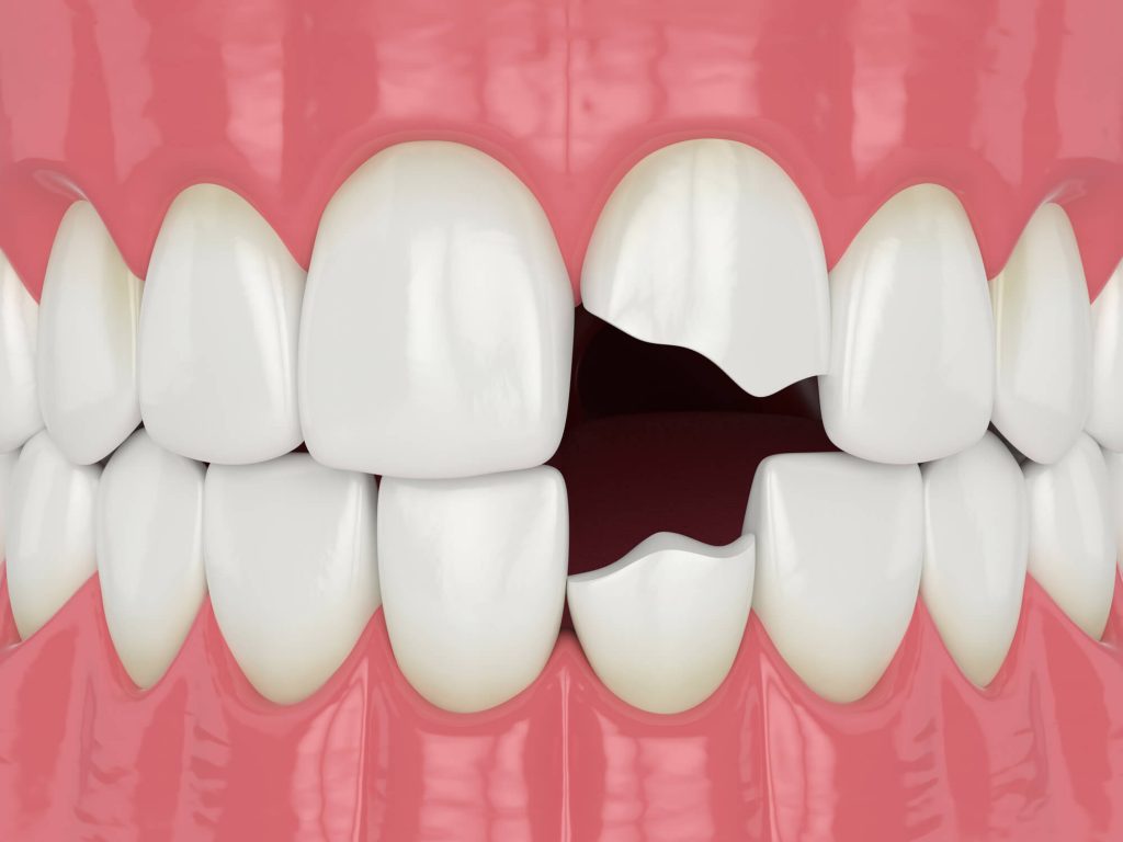 chipped and broken teeth needing Emergency dentistry 33317