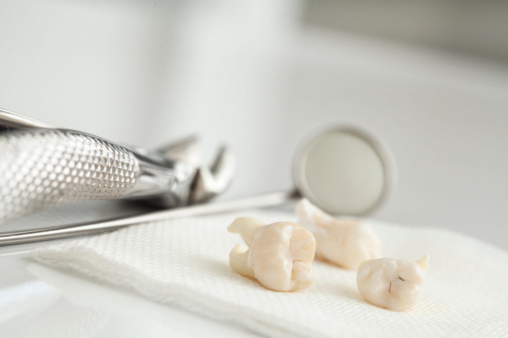 teeth Extractions 33330
