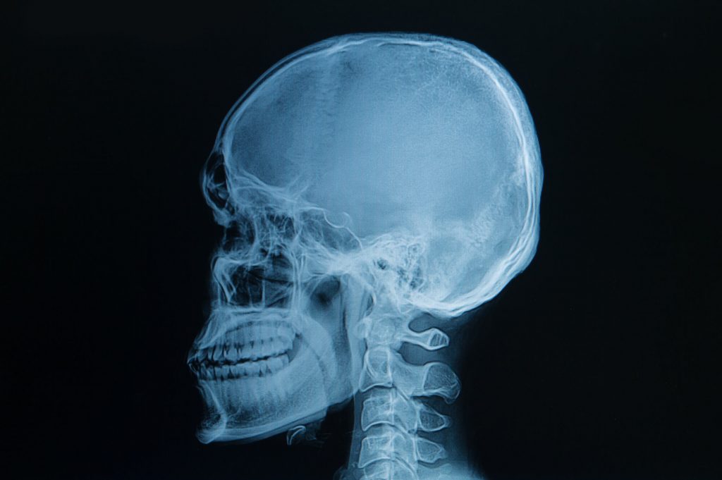 result of cephalometric dental x-rays in 33324