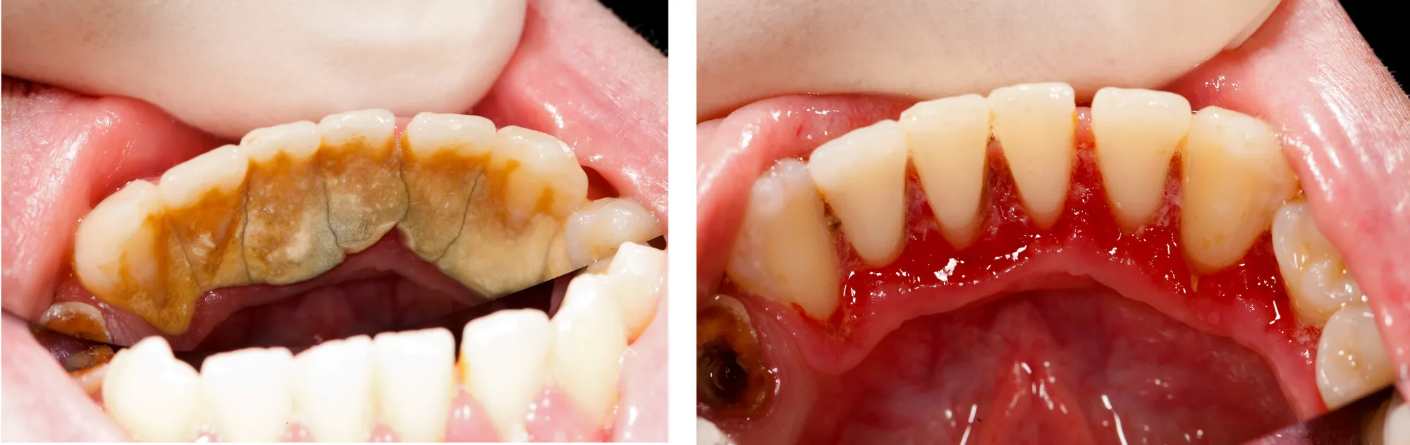 Comparison of teeth that undergoes teeth cleaning Fort Lauderdale, FL and teeth that didn't