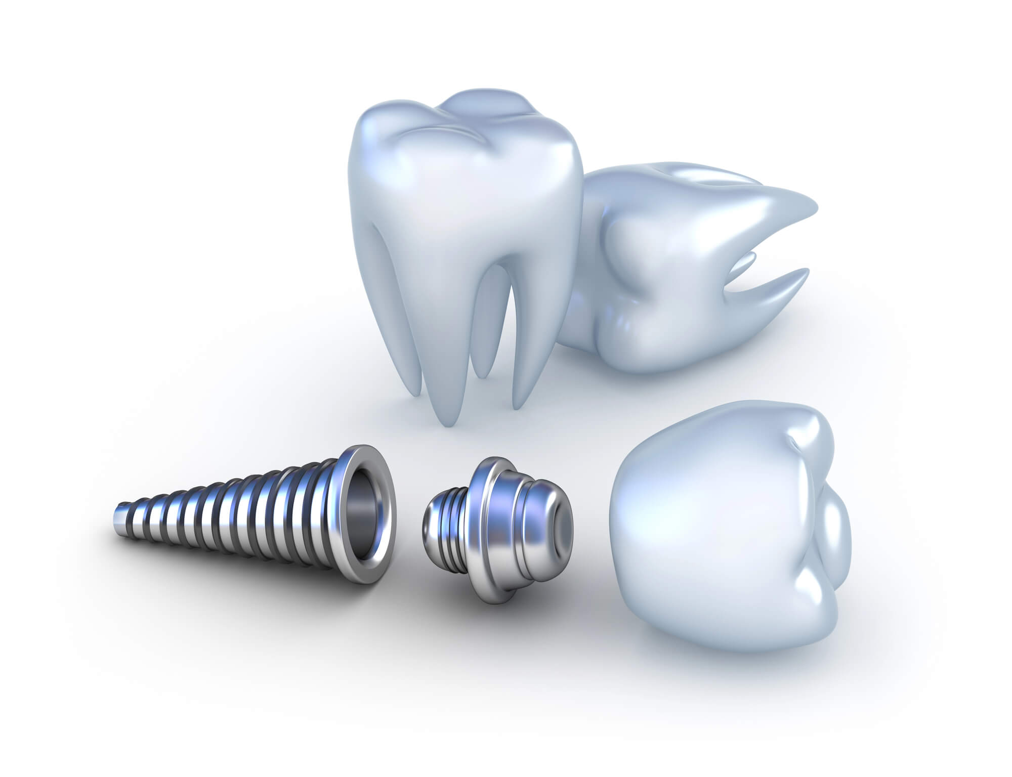 Implants in Fort Lauderdale, FL (1)