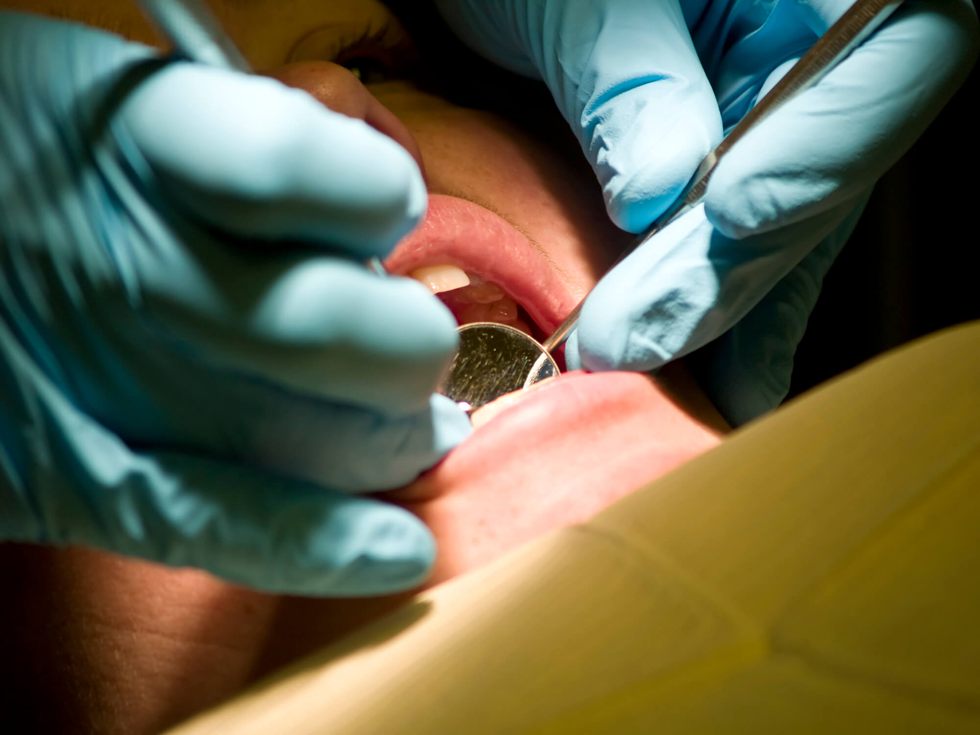 Close up of the best dentist in plantation fl checking for cavities