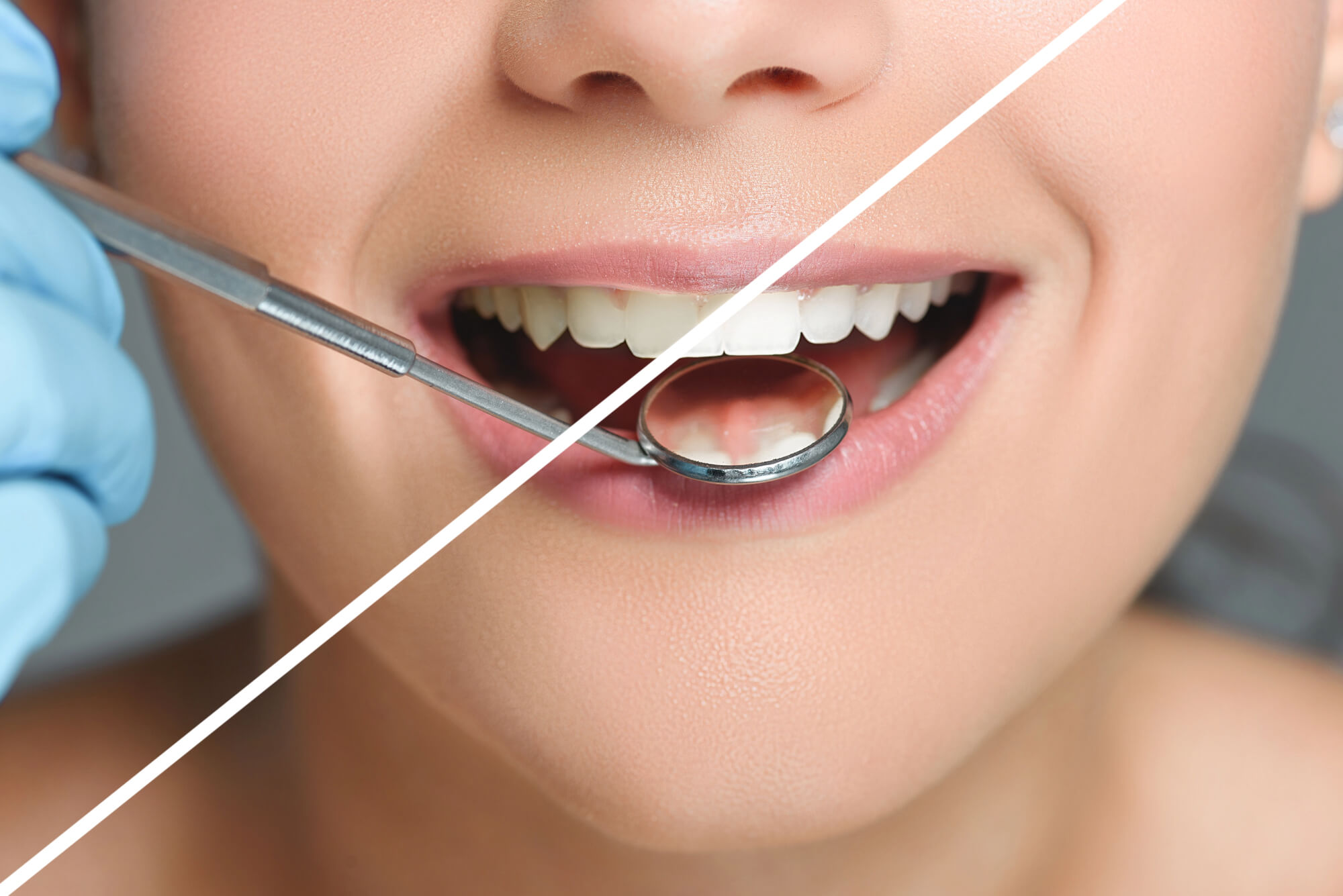 before and after plantation teeth whitening