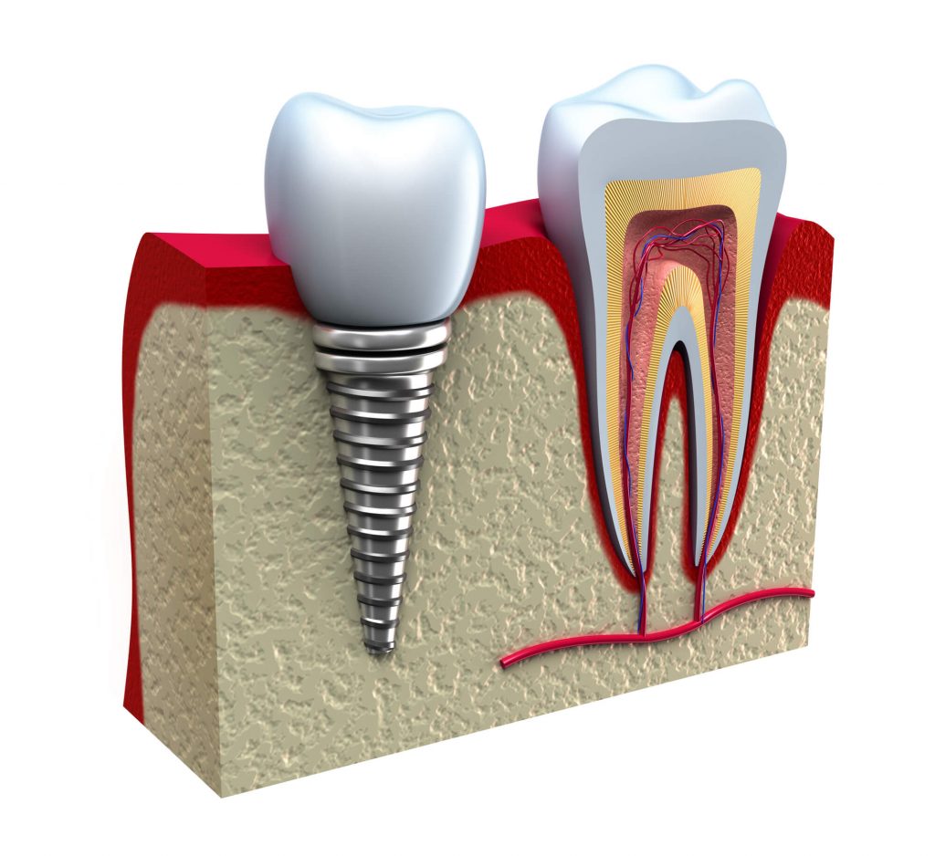  Implants in Fort Lauderdale, FL