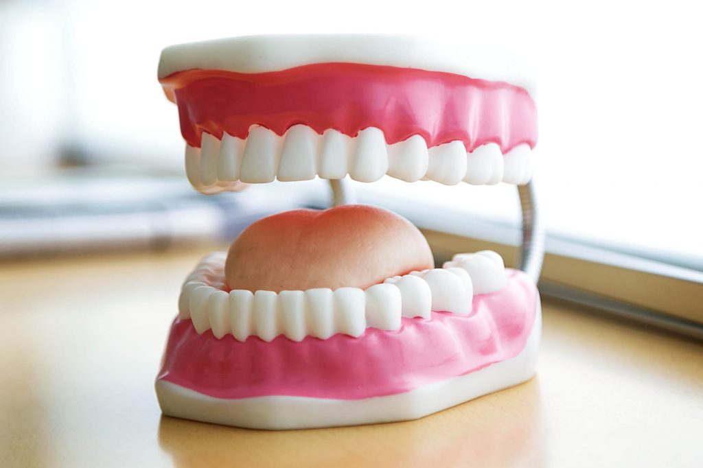 3D model of dentures before showing implants in 33317