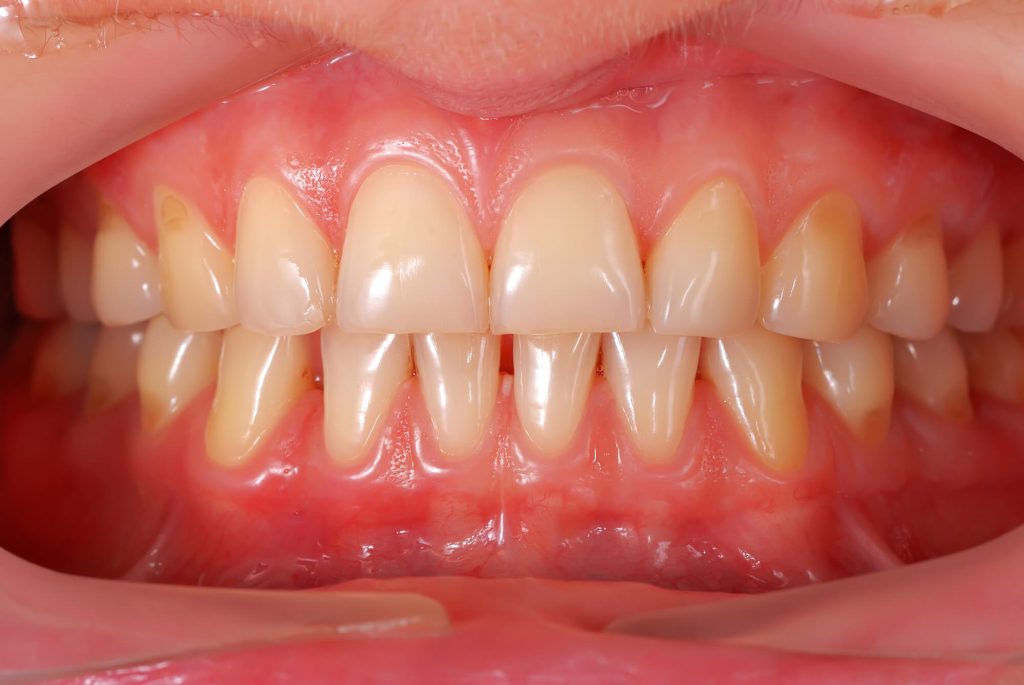 patient shows teeth to justify that he needs teeth whitening in Plantation, FL