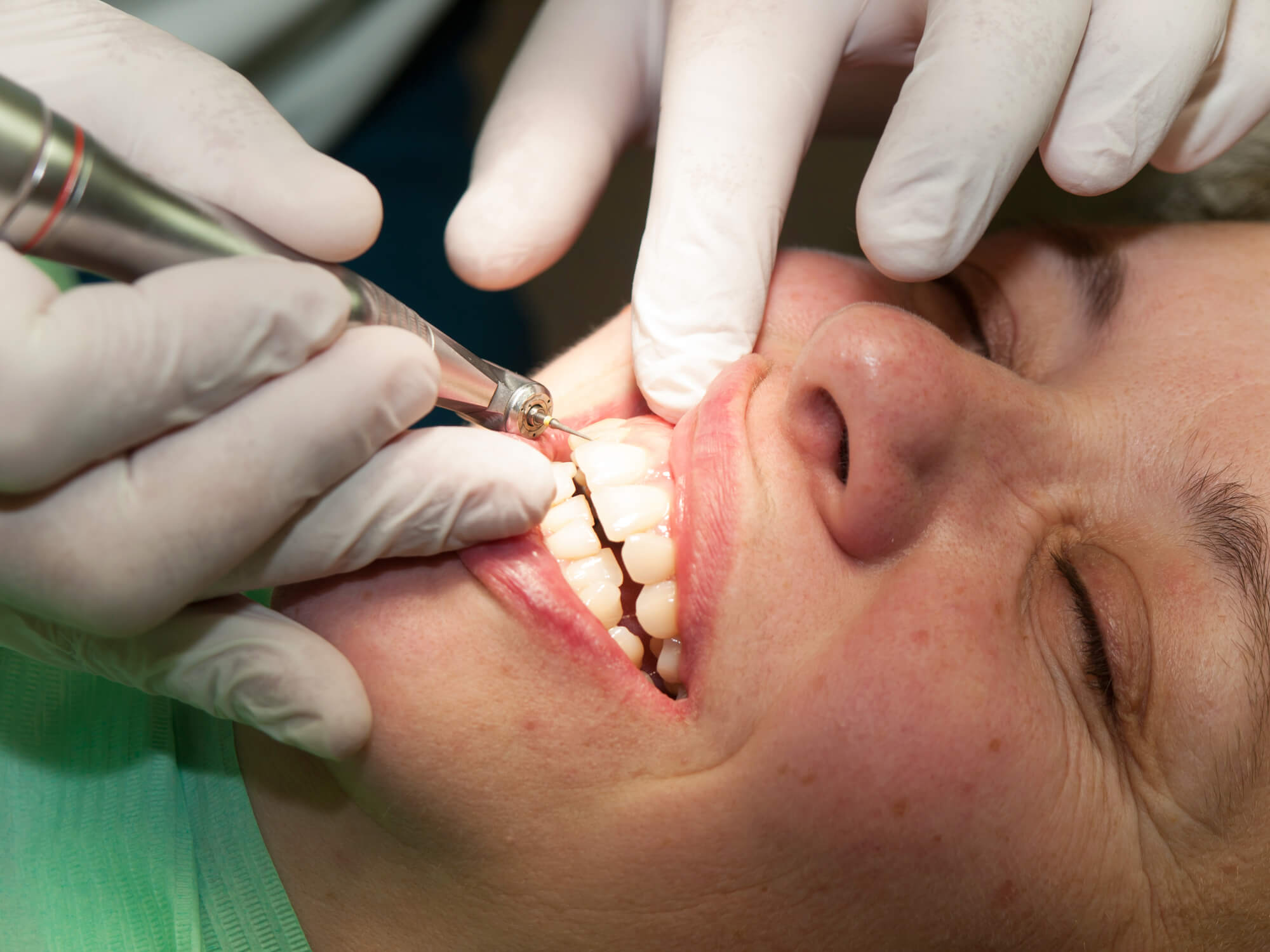 close up of a person's face while getting cosmetic dentistry treatment in Davie, FL  