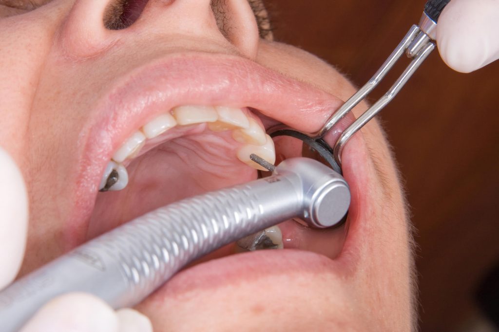 Dentist Checks Dental Filling in 33323