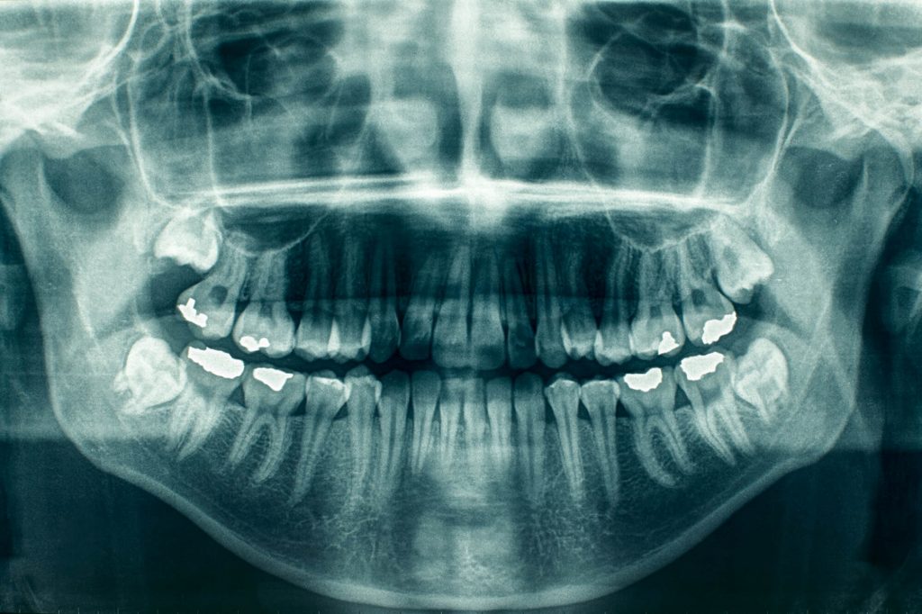 result of panoramic dental x-rays in 33324