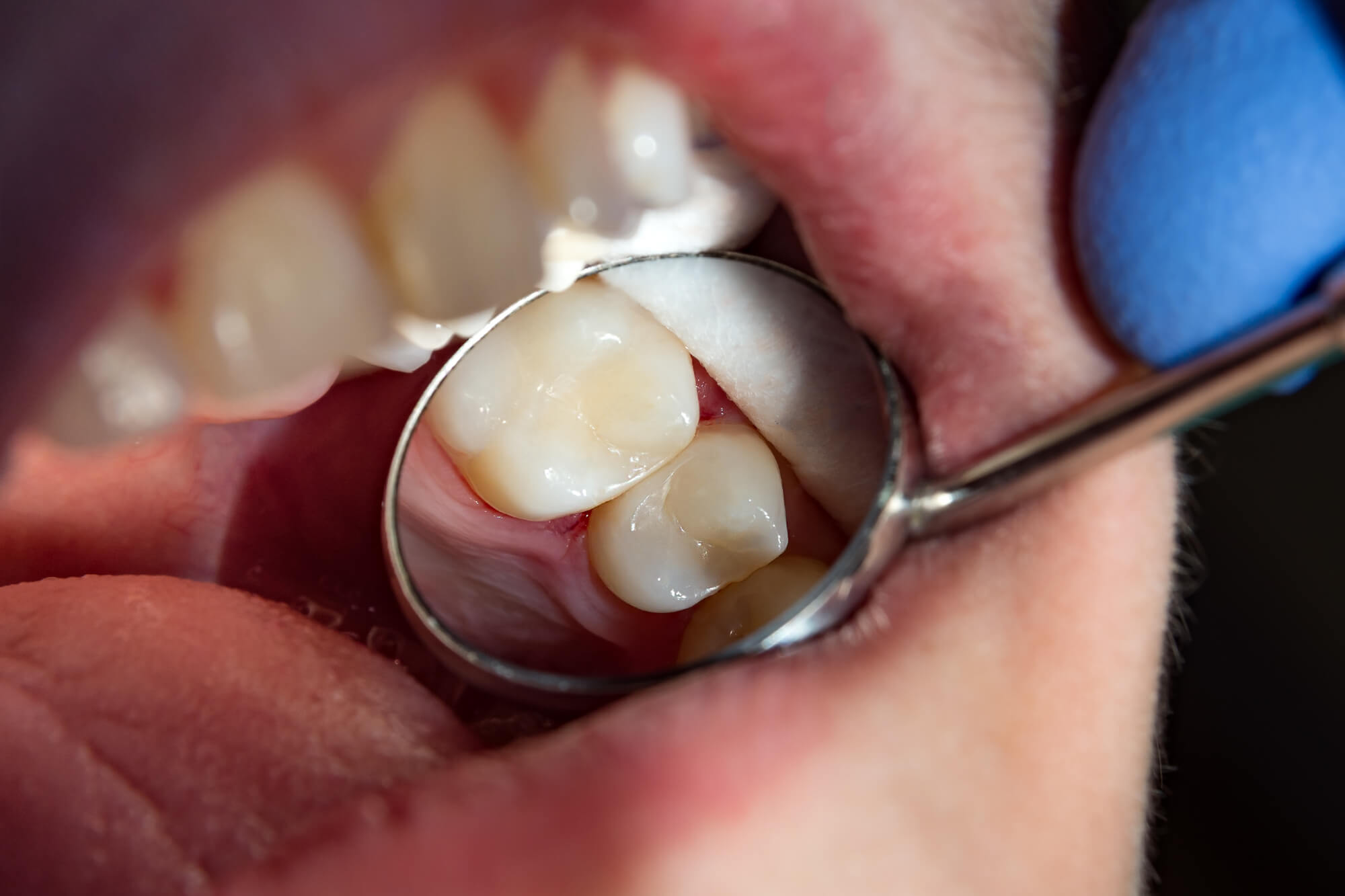 Close up of a patient's teeth while doctor checks if he needs to perform Extractions in Plantation Fl fl