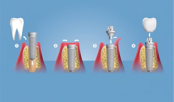 Restoring Your Smile with Confidence at Peninsula Dental Associates