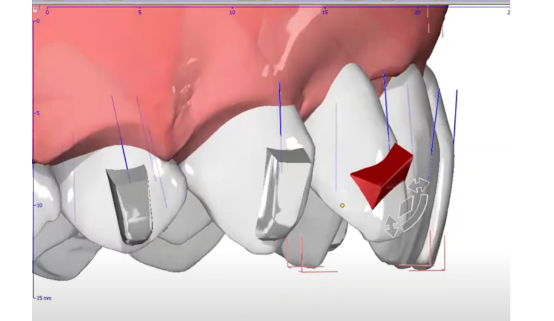 Mastering the PIR Protocol: My Sequential Approach to Class II Division 2 Treatment