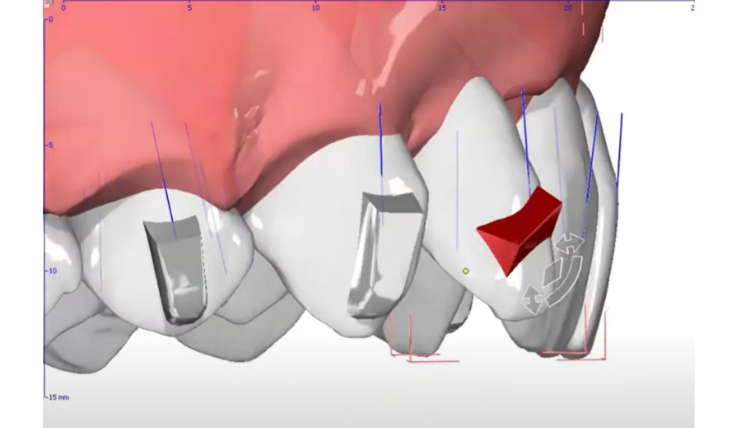 Mastering the PIR Protocol: My Sequential Approach to Class II Division 2 Treatment