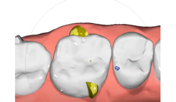 Improving Molar Rotation with a Dual Attachment Strategy
