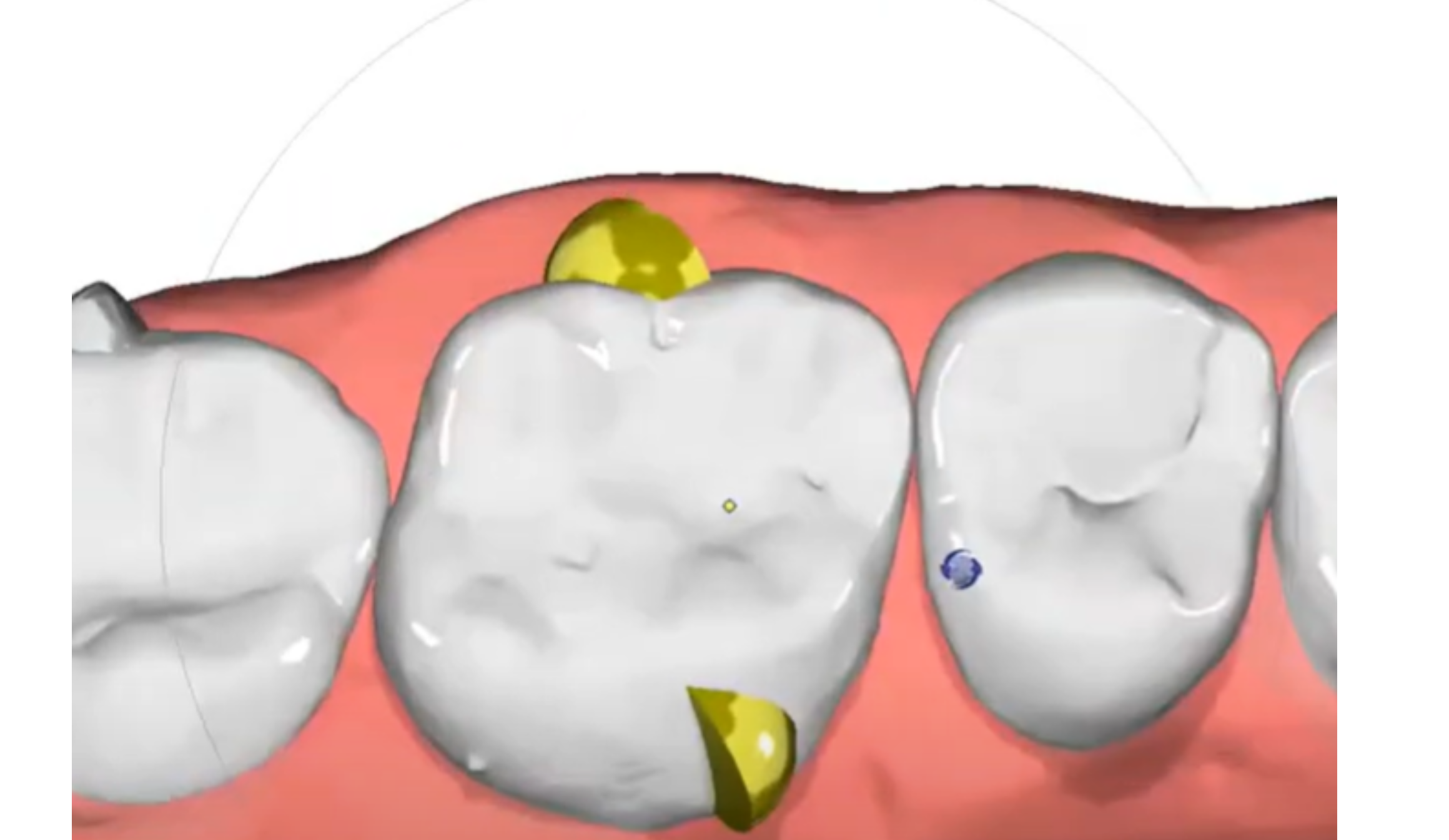 Improving Molar Rotation with a Dual Attachment Strategy