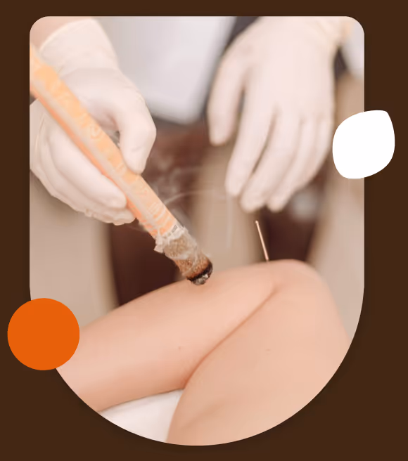 Practitioner wearing gloves holding a lit moxibustion stick near an acupuncture needle on a person's knee.