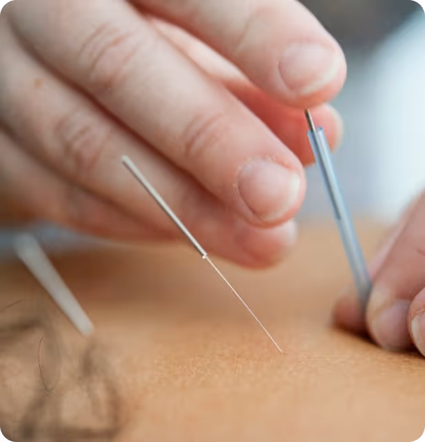 Close-up of hands inserting a thin acupuncture needle into the skin.