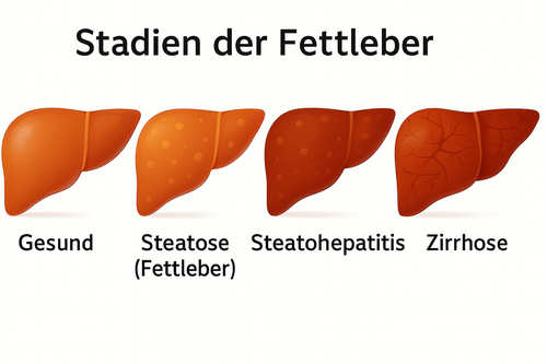 Four illustrations showing stages of fatty liver disease from healthy liver to steatosis, steatohepatitis, and cirrhosis with increasing damage and discoloration.