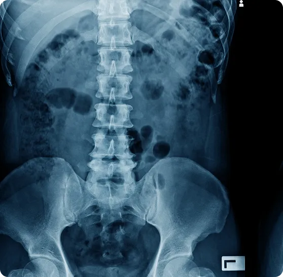 X-Ray