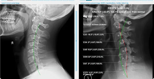 X-Ray