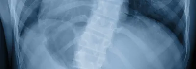 Spine X-Ray