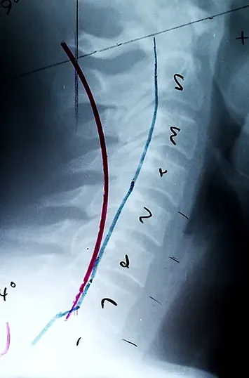 X-Ray
