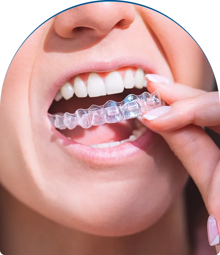 Inlays & Onlays near you