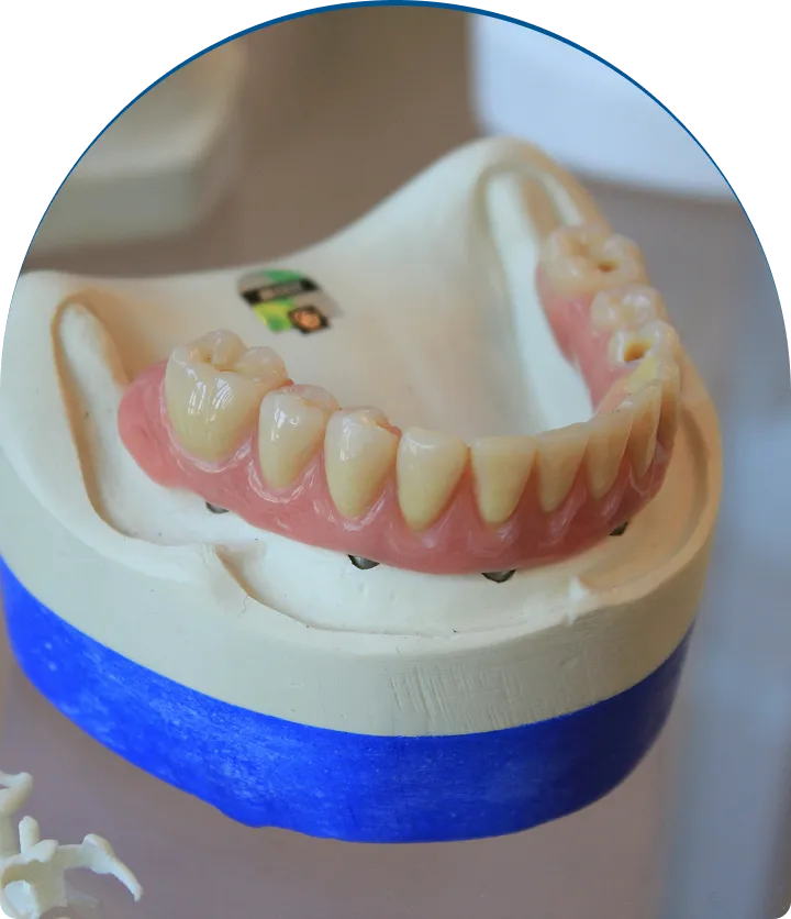 Inlays & Onlays near you