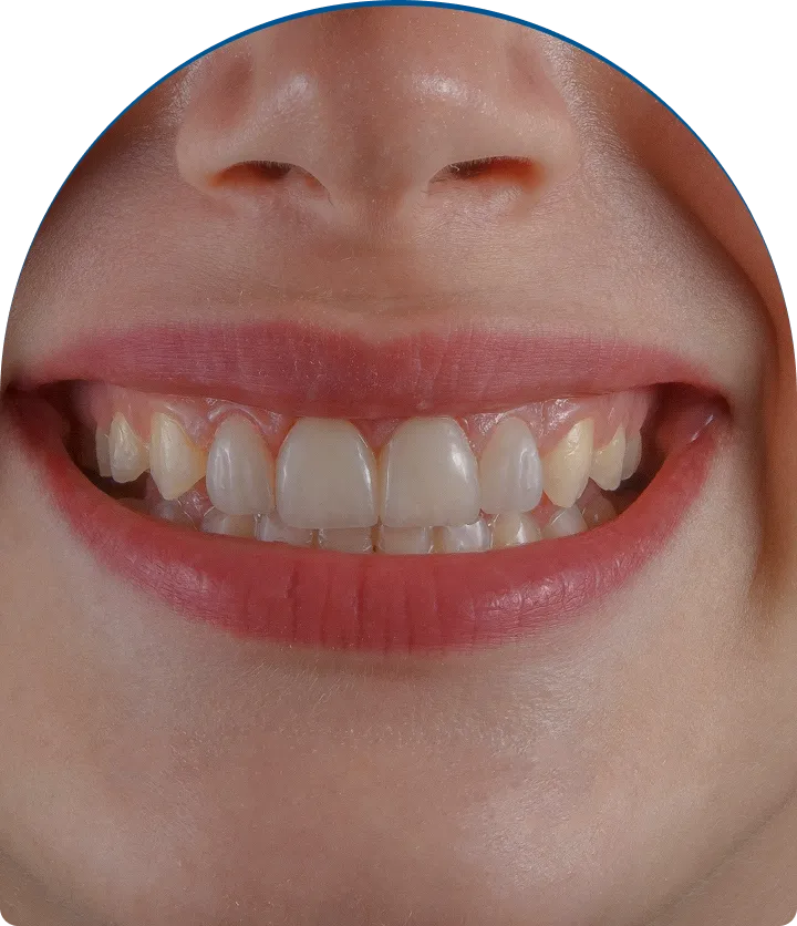 Inlays & Onlays near you