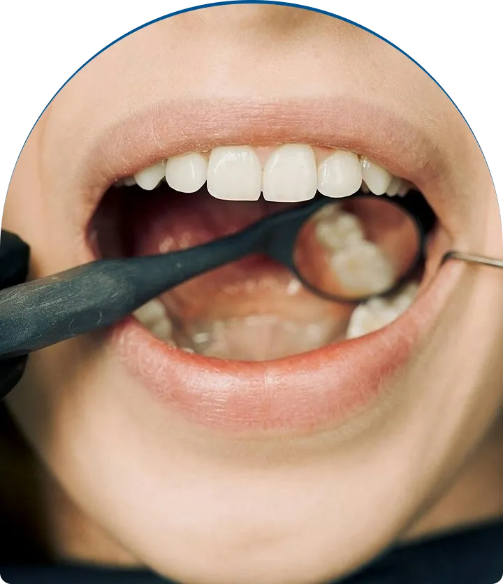 Inlays & Onlays near you